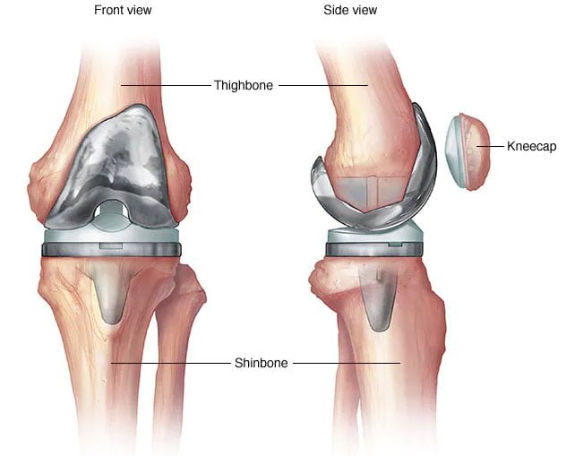 Best Knee Replacement Surgery in Rohini